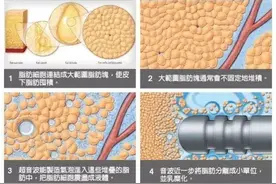 吸脂以后没变瘦，还出现了这些吸脂后遗症怎么办？图片
