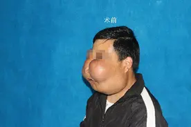 整张脸像“河马”，坐公交曾吓哭小朋友！上海九院为29岁小伙治罕见顽疾图片