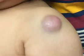卡介苗接种部位脓肿图片