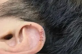 看着都疼！厦门一小伙理发时耳朵被剪伤，缝了6针图片