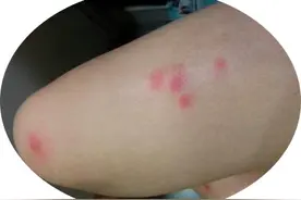 夏天睡凉席，身上发痒过敏是怎么回事？图片