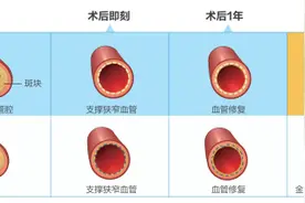 解决传统心脏支架手术痛点 助力血管“再造”图片