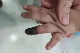 痛心！家人错误包扎，3岁女童手指坏死被截指图片