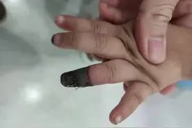 痛心！家人错误包扎致3岁女童被截指图片