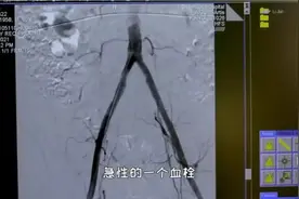 健康 | 年龄每增长10岁，“腿梗”发生率增加2倍！这些人群要警惕图片