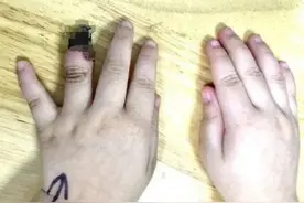 痛心！3岁女童手指坏死只能截除，只因一片创可贴！这个错误千万要小心……图片