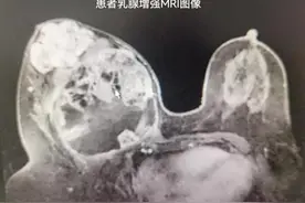 不要忽视乳房自检！40岁女子双乳大小不对称，检查后右侧乳房被切除图片