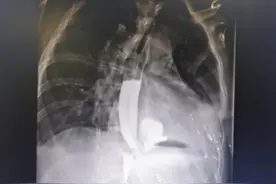 酒醉呕吐能有好凶险嘛？华西专家说，没得好凶，也就是把食管吐破裂而已…图片