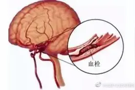 脑血栓来临前会有这4个症状图片