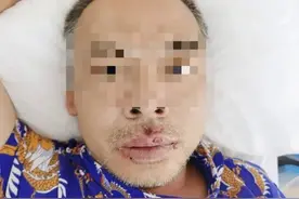 邻居家的猪“热死”了，湘潭男子买回便宜板油炼油，结果全身剧痛差点没命图片