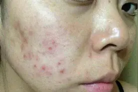 女子花6000元祛斑遭“毁容”？医生怒了：提醒多次没人听图片