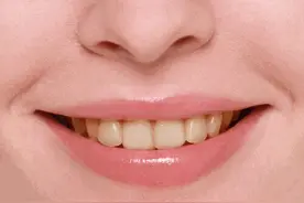 有点黄的牙齿才正常！美白牙贴可能“杀死”牙髓细胞图片