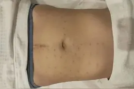杭州妈妈填充胸部，一台1万元手术两次“转手”成15.8万元！还做坏了......图片
