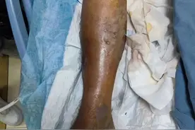 女子海边玩一下午，第4天竟被截肢！医生惊叹：十多年没碰到过图片