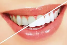 不打磨牙齿的美牙，真的没伤害？图片