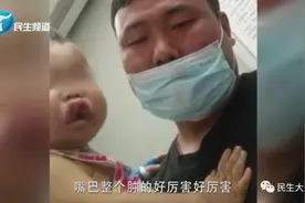 1岁孩子嘴唇上翻，两天后被确诊白血病，孩子妈妈：当时还以为是上火了图片