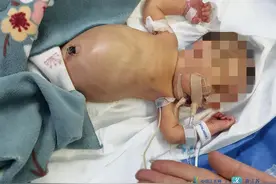 宝宝出生三天突发罕见胃穿孔 南京市妇幼多学科联手成功营救图片