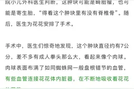 惊呆！9个月大女婴肚里竟藏着胎儿，还在继续长大……图片