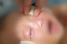 宝宝经常泪汪汪，小心新生儿泪囊炎作怪图片