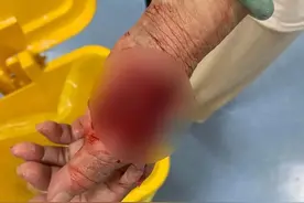 缝针+植皮！北海一妇女被自家狗咬伤，撕裂一大块皮肉图片