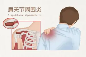 肩周炎康复常用的锻炼方法图片