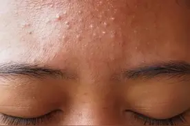 磨人的痘印和色斑，到底怎样才能去掉？图片