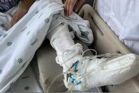 雨水中蹚行被铁丝扎伤左脚，郑州男子险些截足图片