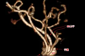 高致死性脑动脉瘤破裂出血，3小时精准手术成功拆“炸弹”图片