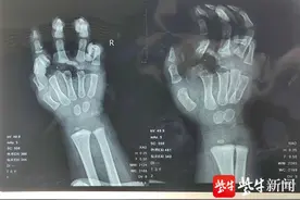心疼！20个月男娃手掌被切断图片