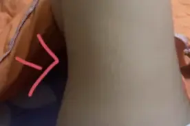 借2万“整形贷”，抽脂后两腿不对称了？！女子傻眼图片