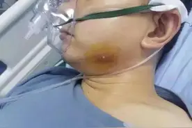 休克、呼吸困难！湖南男子随手挤个痘痘，被送进医院抢救...图片