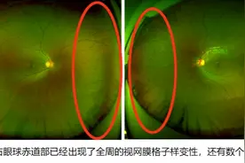 8岁近视900度，还有视网膜裂孔！手机+偏方差点致他失明图片