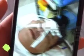 男子景区乘观光车脸被撞缝13针形似灰太狼：我要是再婚，会不会受影响图片
