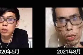 肠癌一年，年轻小伙面目全非！癌症的可怕，让你来不及说后悔图片