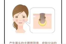 用“魔法”把鼻子变漂亮，教你正确去黑头图片