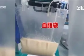 佛山一男子血液成“牛奶色”，与其饮食习惯有关图片