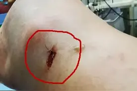 浙江男子被“超级毒蛇”咬了一口！自己一通神操作惊呆网友图片