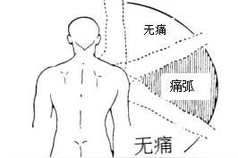 怎么会得肩周炎？如何预防和治疗？看这里→图片