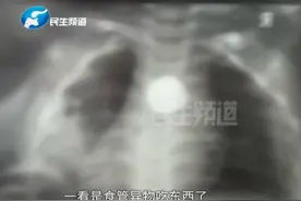 郑州一岁宝宝误吞异物，食道被腐蚀穿孔！家长们一定要多注意此类物品图片