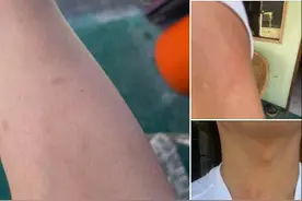 毛虫致人过敏？台湾屏东大量民众皮肤现红疹图片