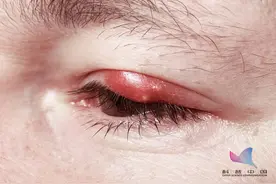 可怕！一男子吃火锅后险些致盲，罪魁祸首竟是眼皮上的"痘痘"…图片