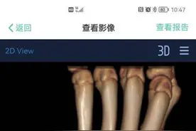 10岁男孩摔伤致左腕骨折，医生手法复位免开刀之苦图片