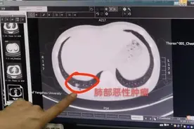 扬州11岁女孩咳嗽高烧不退，医院检查发现竟患上肺癌图片