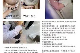 花费近两万给婴儿戴石膏头模矫正头型？更需要“矫正”的是育儿观图片