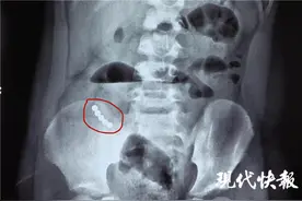 5岁男孩吞下5颗磁力珠，肠道磨穿4个洞图片