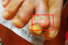 这两种食物经常一起吃，福州一依伯差点截肢图片