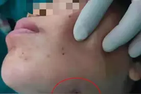 女子智齿反复发炎，结果脸颊烂穿一个洞……图片