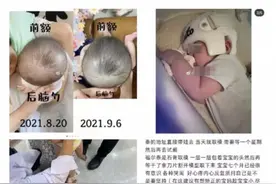 2.8万的“头盔”让婴儿头型变美？医生：影响发育图片