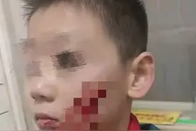 吴起一小学生校内被同学划伤面部，缝了7针图片
