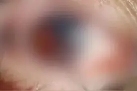 女孩眼球破裂、天花板被打穿……保温杯+枸杞红枣=定时“炸弹”图片